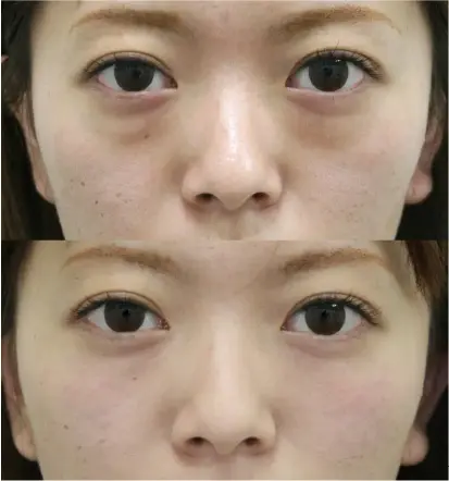 ヒアルロン酸注入 – 目の下のクマ、くぼみ、たるみ治療 | セオリー