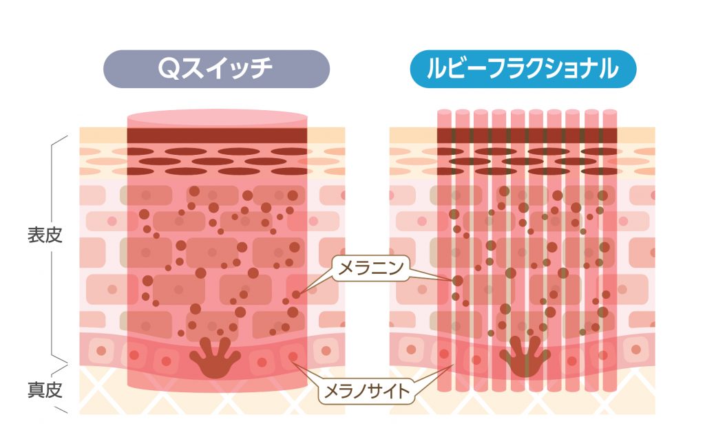 Qスイッチとルビーフラクショナルの違い
