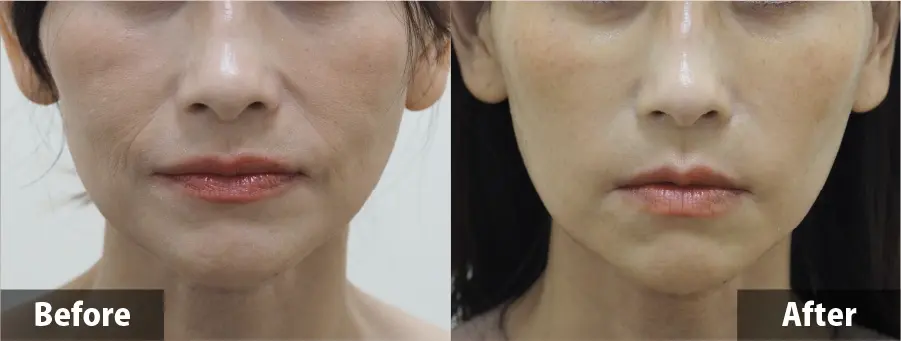 ヒアルロン酸リフト | セオリークリニック- 東京・銀座の美容外科