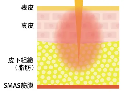 ボルニューマ（RF・高周波）によるほうれい線・シワ・顔のたるみ治療