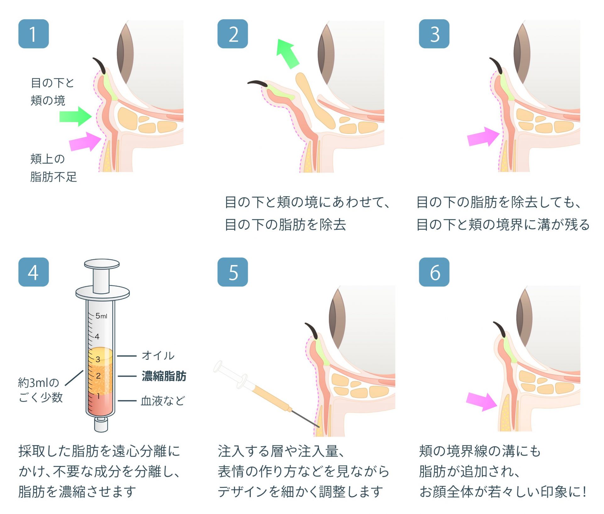 経結膜脱脂+リポトランスファー