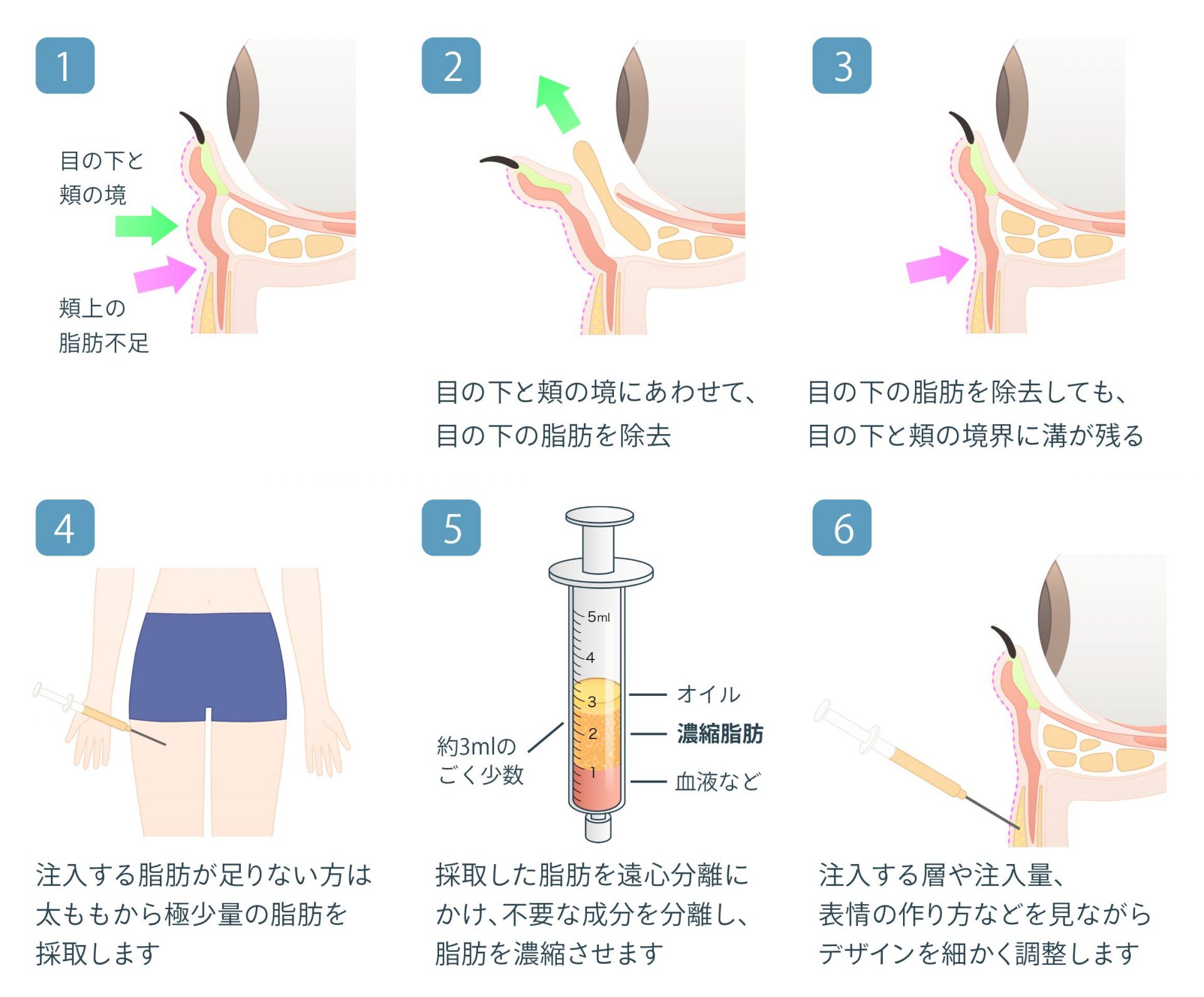 経結膜脱脂+リポトランスファー+脂肪注入