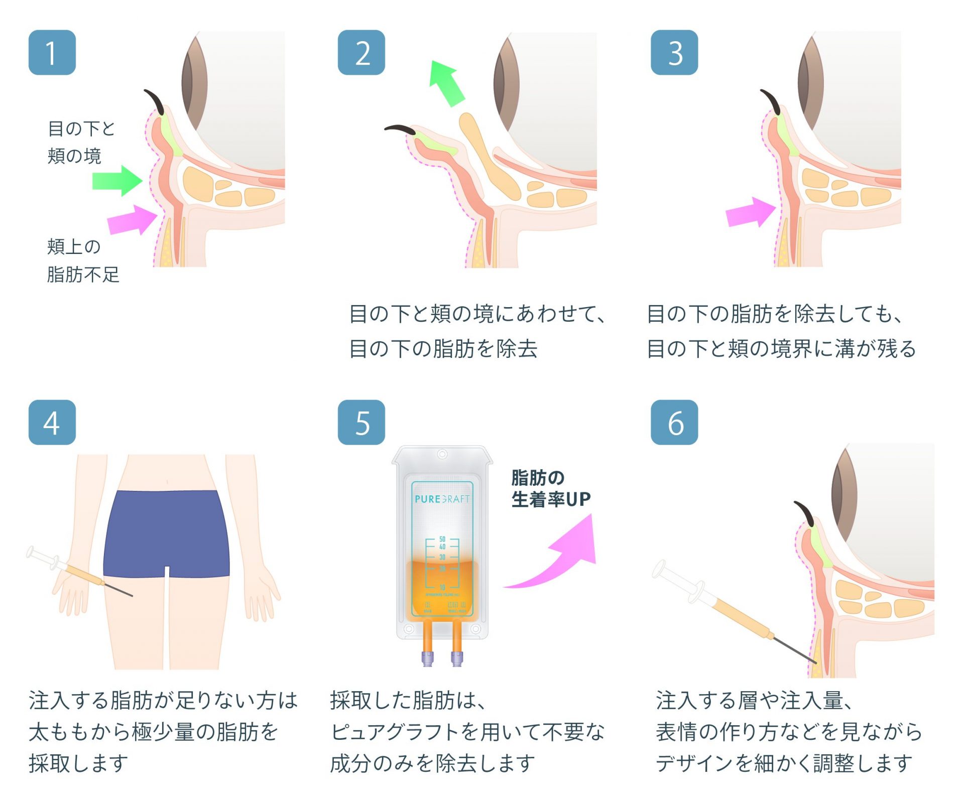 経結膜脱脂+ピュアグラフティング
