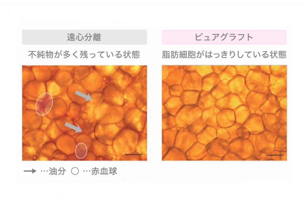 ピュアグラフティング脂肪注入