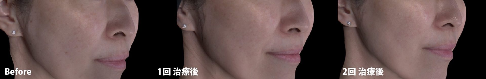 ルビーフラクショナル ビフォーアフター