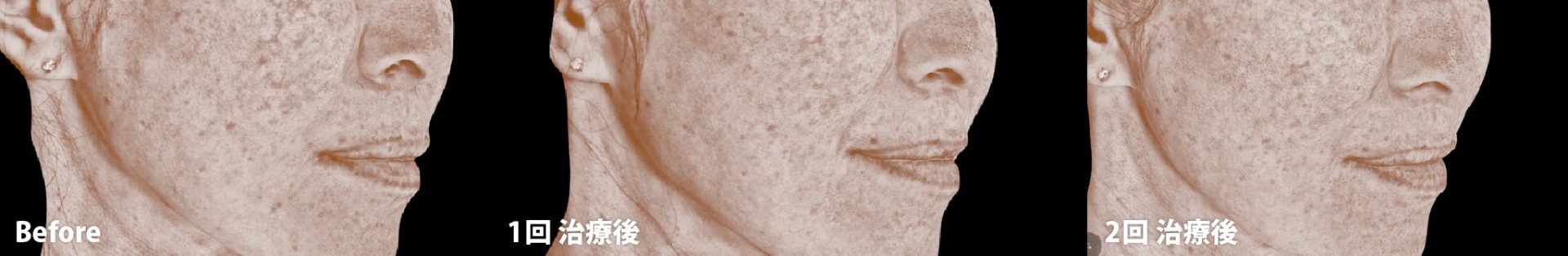 ルビーフラクショナル術後の経過