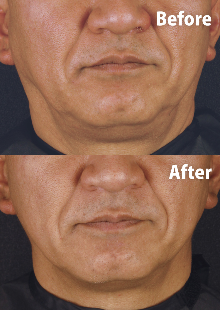 ソフウェーブのビフォーアフター