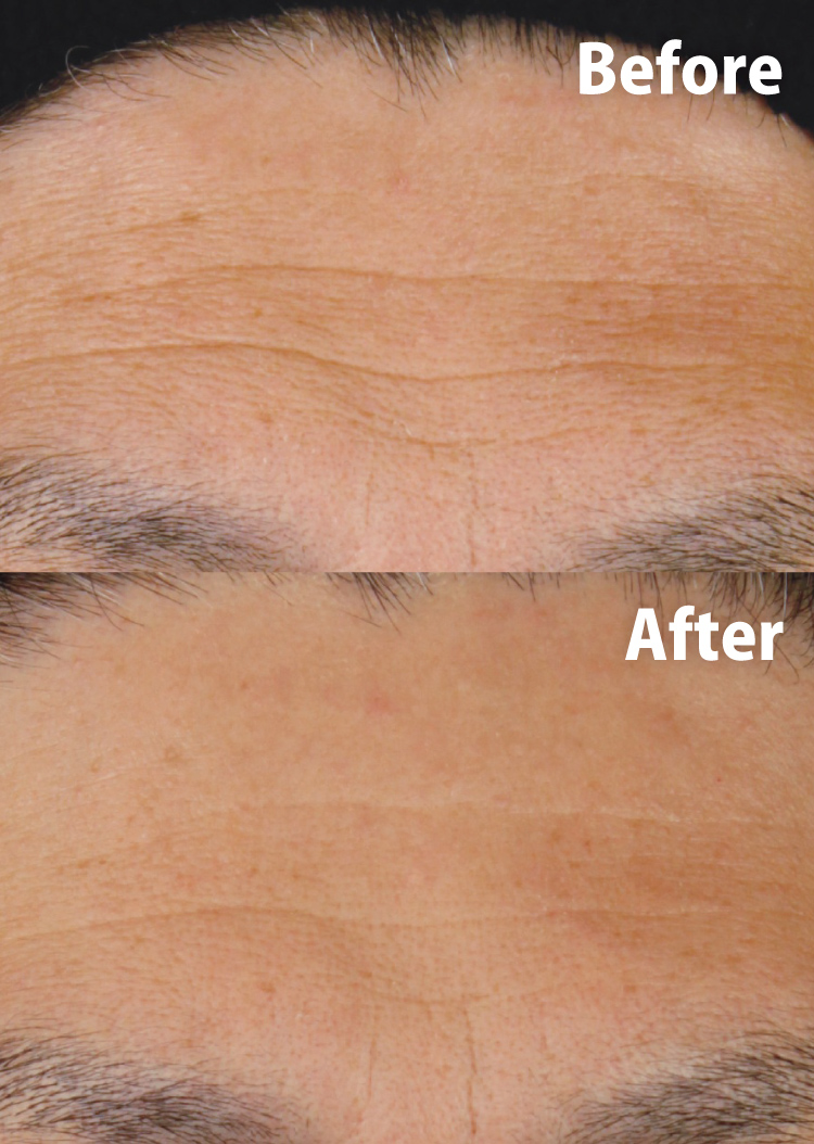 ソフウェーブのビフォーアフター