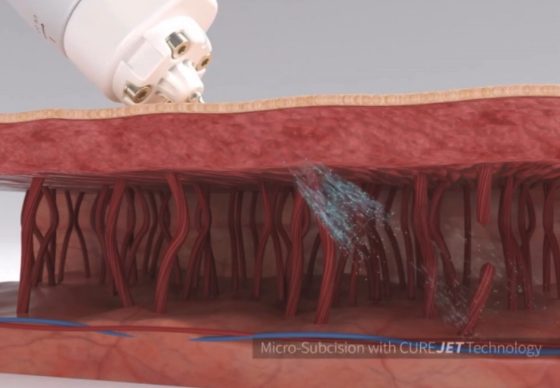 キュアジェットによる薬剤注入