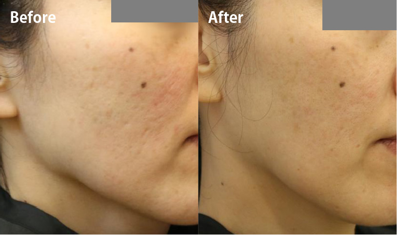 キュアジェットのビフォーアフター