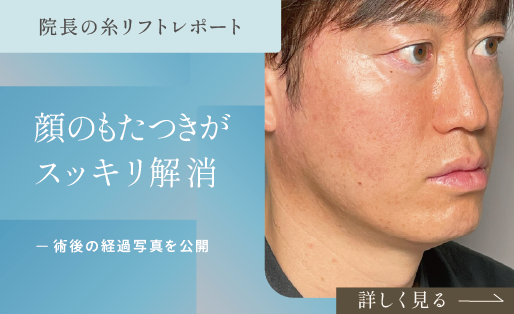 糸リフト（新世代スレッドリフト）によるほうれい線治療 | セオリー