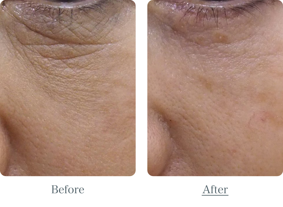 目の下のシワ取り　ビフォーアフター