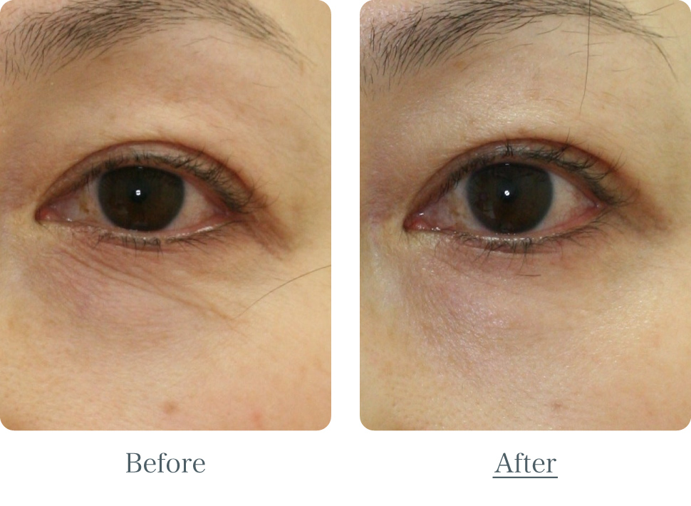 目の下のシワ取り　ビフォーアフター