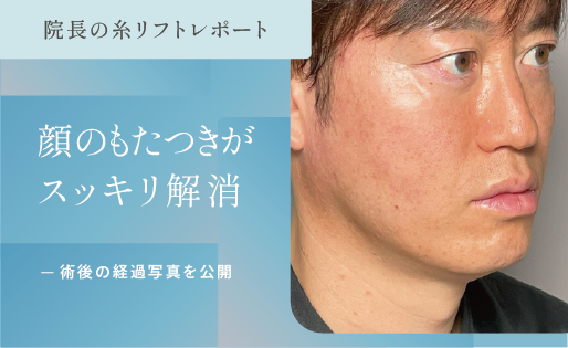 糸リフト（新世代スレッドリフト）によるほうれい線治療 | セオリー