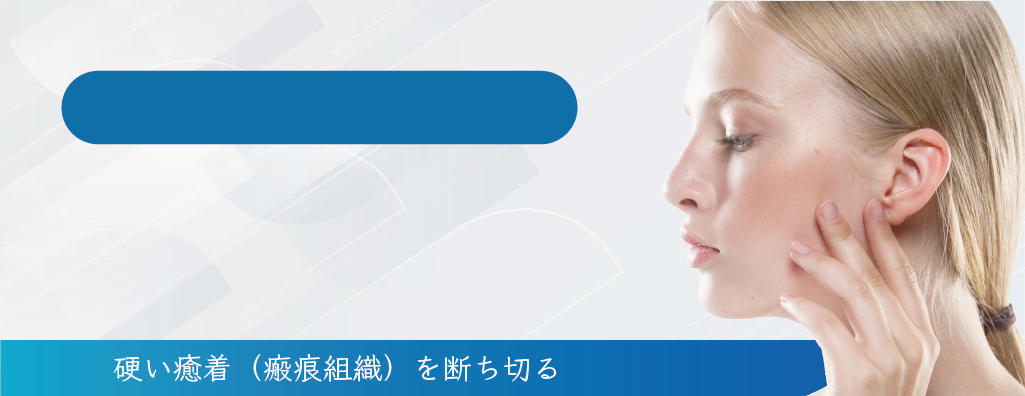サブシジョン