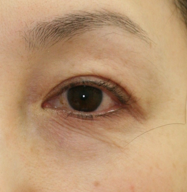 施術前　目の下のシワ取り施術前。皮膚のしわっとした感じが気になります。