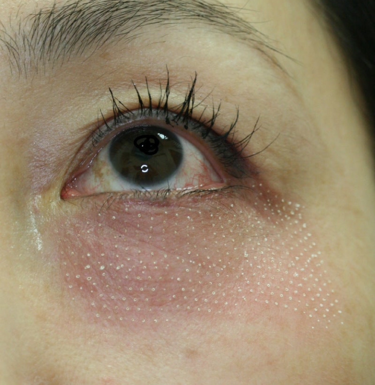 照射直後　目の下のシワ取り施術直後。白いドット状の照射痕がつきます。