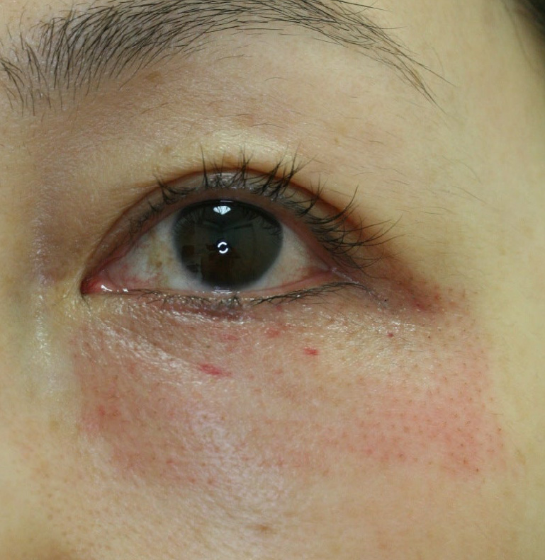 翌日　目の下のシワ取り施術翌日。赤みや腫れがピークとなり内出血も見られます。