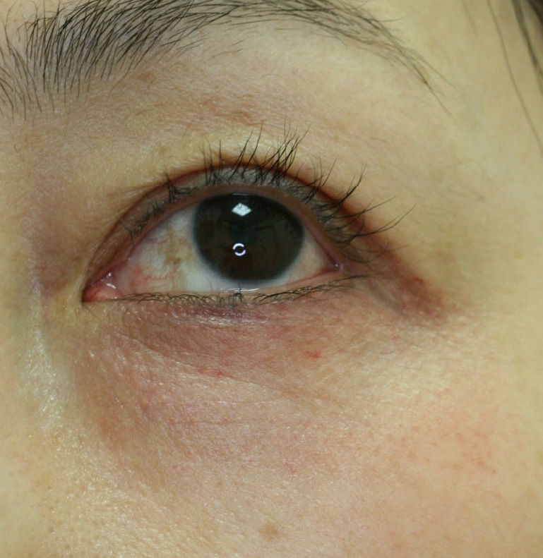 4日目　目の下のシワ取り施術4日目の症例写真。赤みが引いて、ドット跡もほとんどありません。