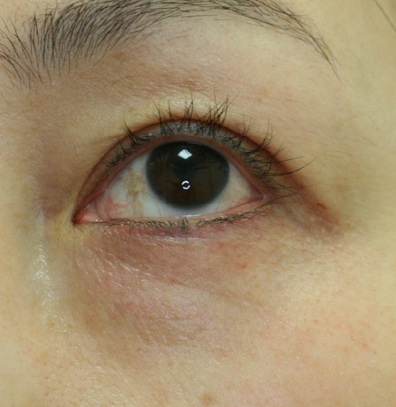 5日目　目の下のシワ取り施術5日目の症例写真。さらに回復してきているのが分かります。