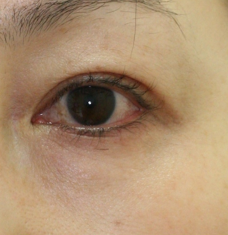 1ヵ月後　目の下のシワ取り施術1ヶ月後の症例写真。皮膚が引き締まりシワが改善
