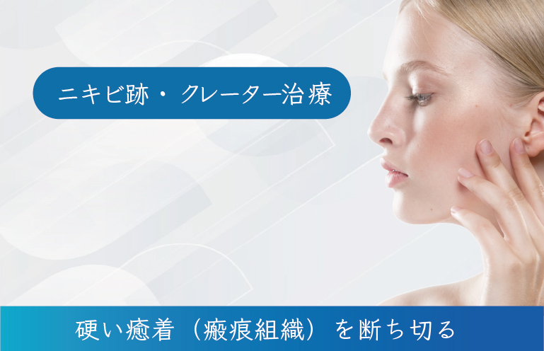 サブシジョン