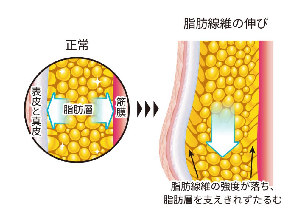 脂肪線維の伸びによるたるみ