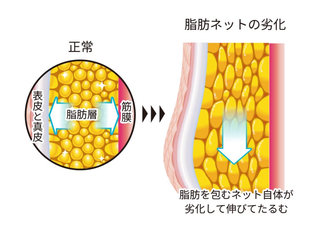 脂肪ネットの劣化によるたるみ