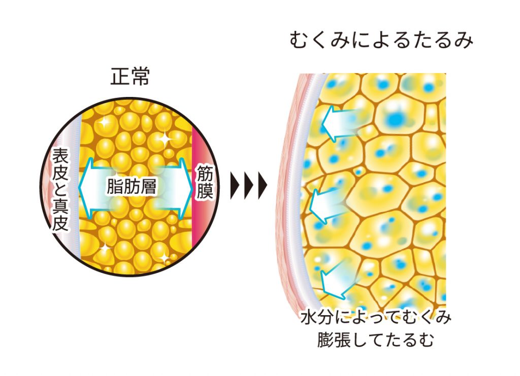 むくみによるたるみ