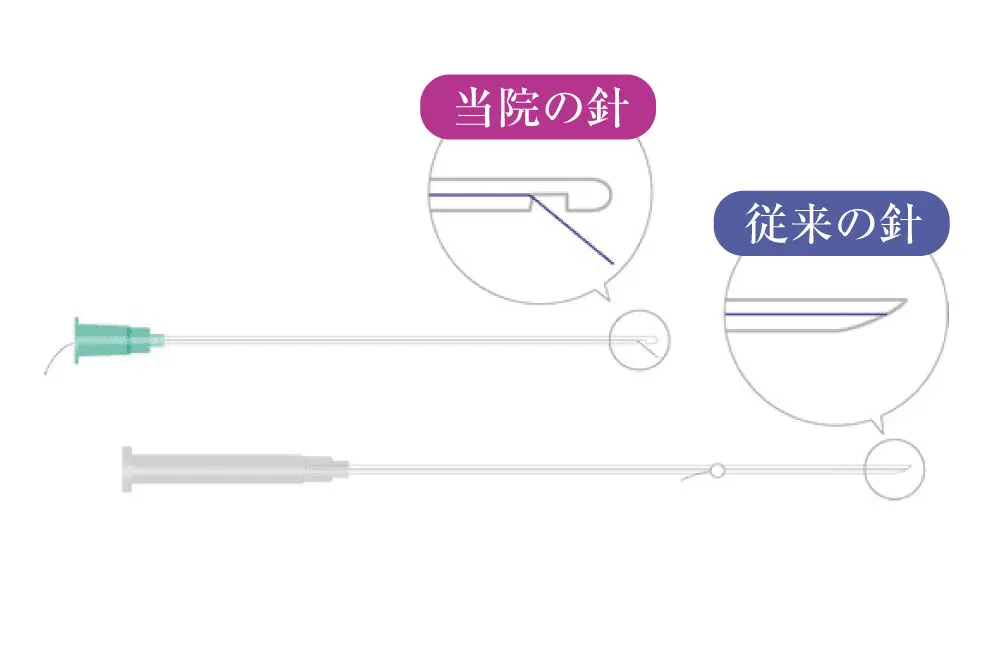 糸リフト（新世代スレッドリフト）によるほうれい線治療 | セオリー