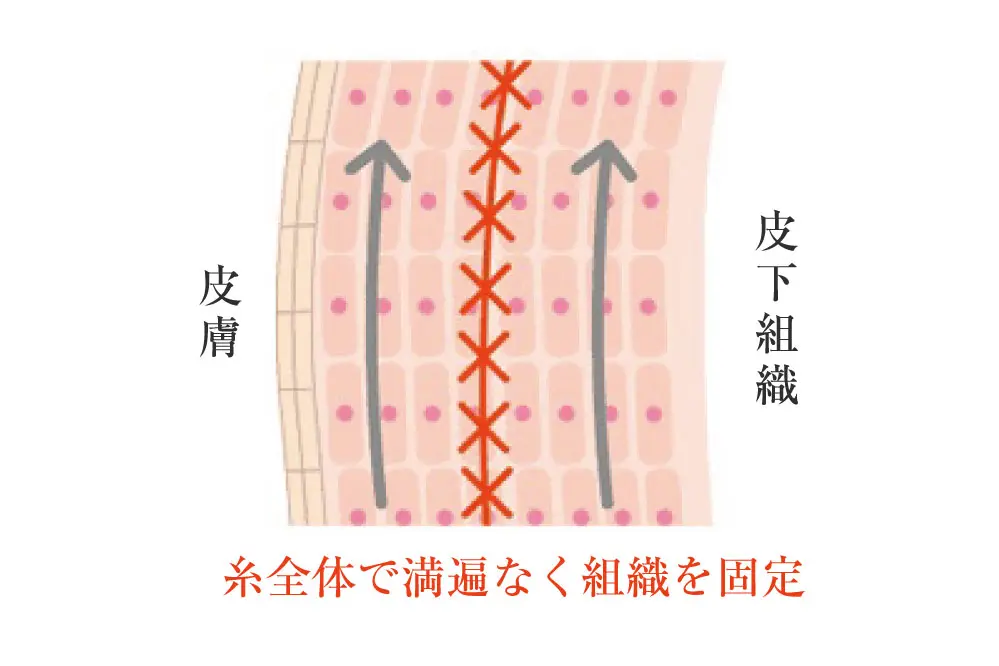 糸リフト（新世代スレッドリフト）によるほうれい線治療 | セオリー